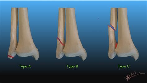 Danis – Weber Classification of Ankle Fractures | UW Emergency Radiology