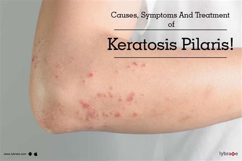 Causes, Symptoms And Treatment of Keratosis Pilaris! - By Dr. Manjiri Bhusari | Lybrate