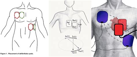 Beyond ACLS: Dual Simultaneous External Defibrillation - REBEL EM ...