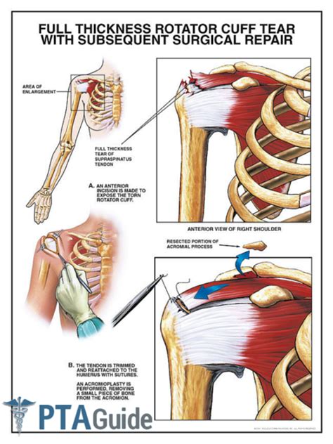 The Complete Rotator Cuff Tear Guide for Physical Therapy Assistants