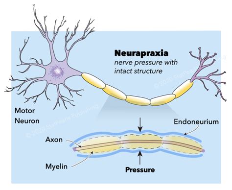 [Figure, Neurapraxia, motor neuron, axon, myelin, endoneurium ...