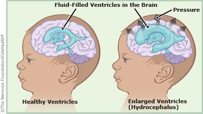 Hydrocephalus: It's All In Your Head