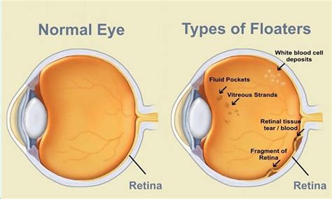 An eye floater looks like a speck in your vision that moves when you ...