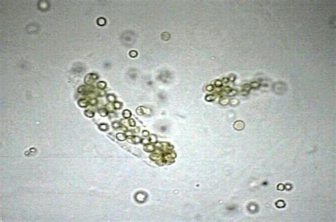 Red Blood Cells Casts in Renal Hematuria | Medical Laboratories