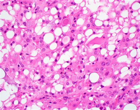 Mucoepidermoid Carcinoma Of Parotid Gland