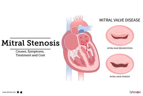 Mitral Stenosis: Causes, Symptoms, Treatment and Cost