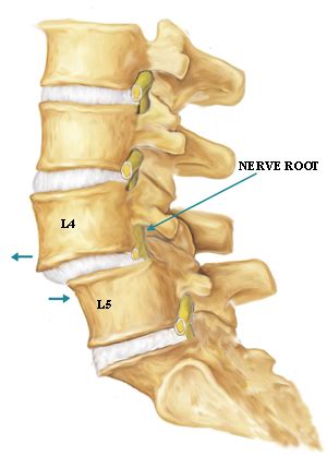 Grades of Anterolisthesis and Its Treatments | Just-Health.net