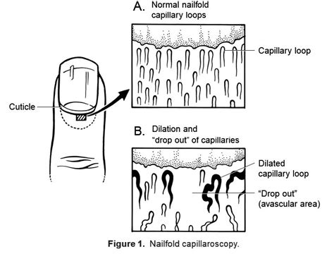 RheumaKnowledgy » Nailfold Capillaroscopy