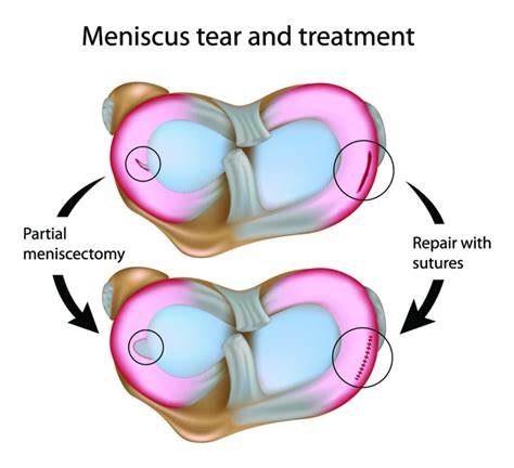 Is it possible to replace a trimmed meniscus tear? | Dr Geier