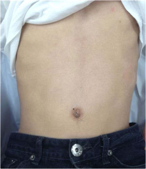 Acute abdominal pain caused by superior mesenteric artery syndrome in a healthy young boy | BMJ ...