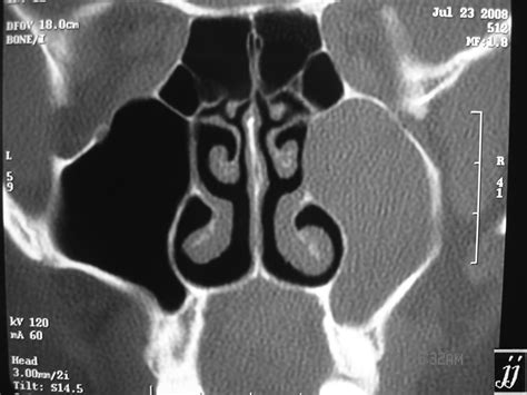 ENT- maxillary sinus retention cyst – Radioogle