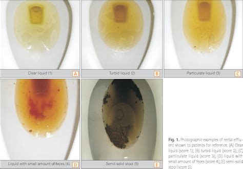 Figure 1 from Patient Descriptions of Rectal Effluents May Help to Predict the Quality of Bowel ...