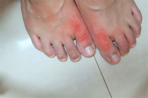 The ULTIMATE Guide to Know Everything about Gout Symptoms