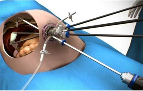 SILS / Scarless surgery is advanced Minimally inva