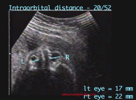 Microphthalmia – ULTRASOUNDPAEDIA