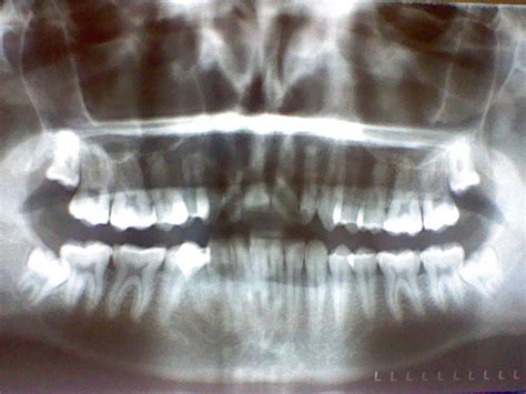 Wisdom Tooth X-ray by Gynandromorph on DeviantArt