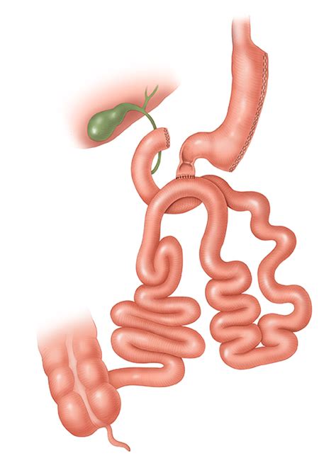 Duodenal Switch Weight Loss Surgery Procedure | Blog Dandk