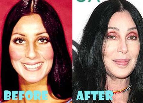 Cher Plastic Surgery Before and After Pictures - Lovely Surgery