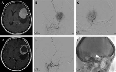 A 41-year-old woman with sphenoid ridge meningioma: (A)... | Download Scientific Diagram