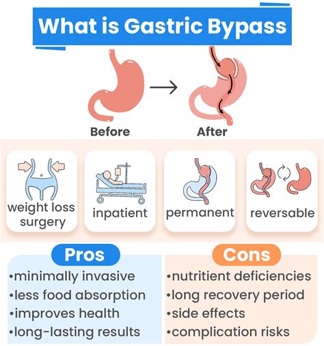 Gastric bypass surgery: how it works, benefits & drawbacks