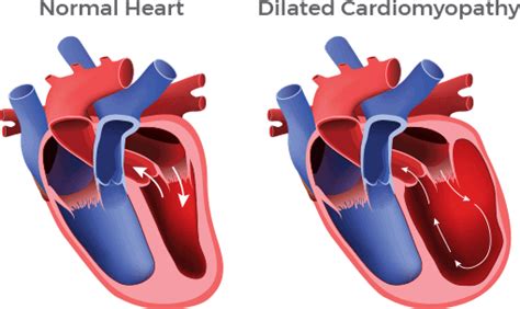 Causes of Dilated Cardiomyopathy and Heart Failure