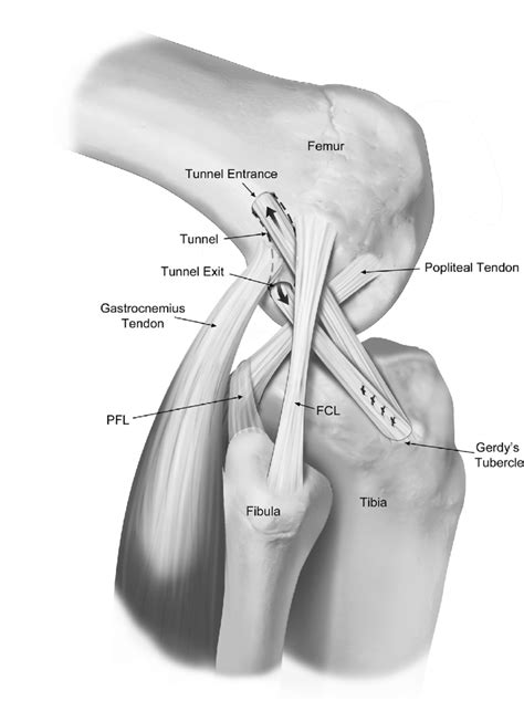 Lemaire technique. 27 (FCL, fibular collateral ligament; PFL ...