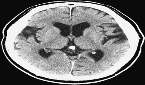 Skew Deviation as the Initial Manifestation of Left Paramedi... : Journal of Neuro-Ophthalmology