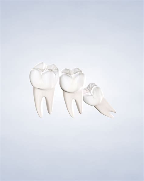 Wisdom Teeth Removal: What to Expect