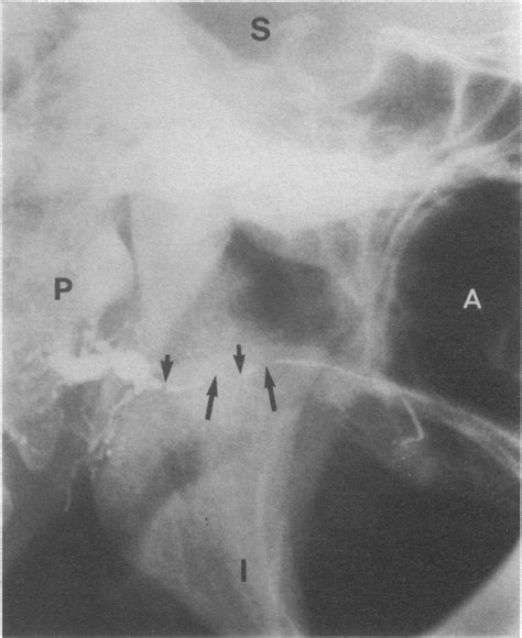 Sialogram of right parotid duct. (Long 'up' arrows indicate strictures ...