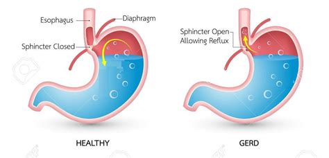 Gastroesophageal-Reflux-Disease-GERD – SIFSOF