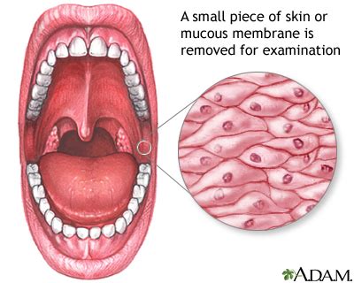 Mucosal biopsy | Multimedia Encyclopedia | Health Information | St ...