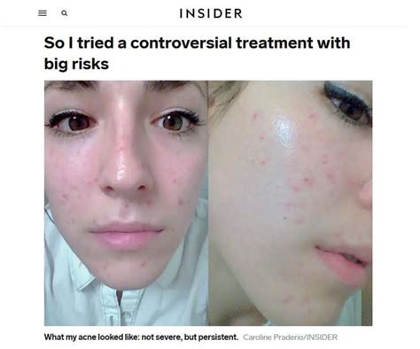 Is Accutane Worth It? Is It Bad to Take Accutane? | Accutane, Mild acne ...