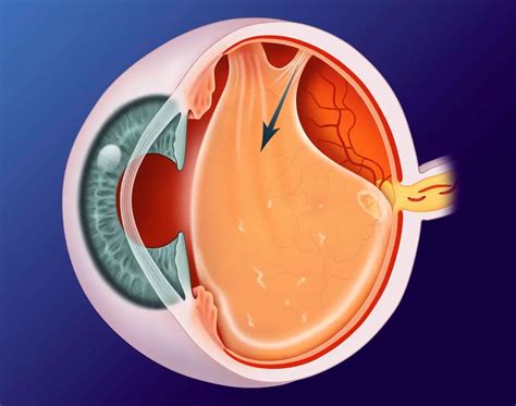 Posterior vitreous detachment - American Academy of Ophthalmology