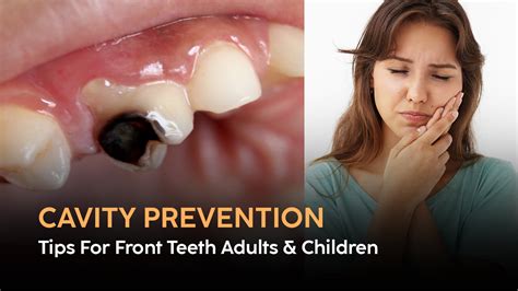 Cavity Prevention Tips for Front Teeth in Adults & Children | Blog