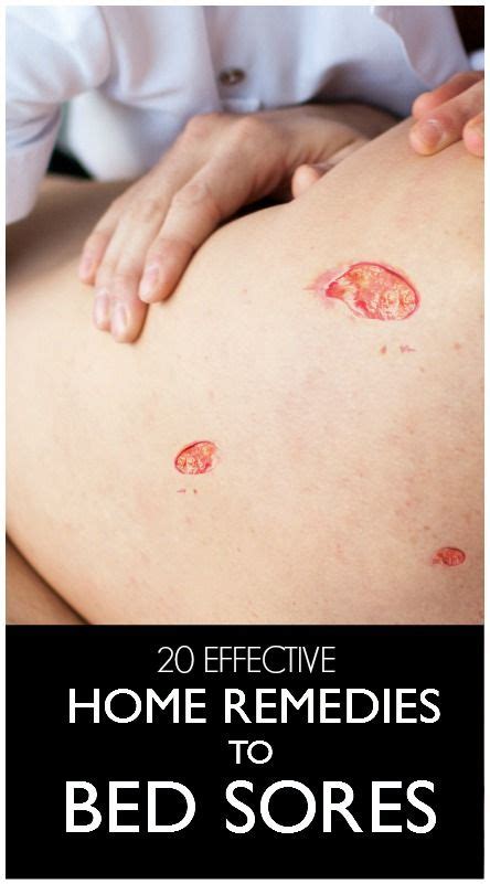 8 Best home remedies for bed sores or pressure sores images in 2020 ...