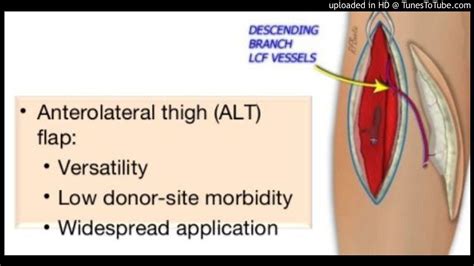 The anterolateral thigh (ALT) flap is a workhorse flap for a variety of wounds - YouTube