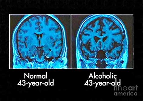 Normal And Alcoholic Brains, Mri Scans Photograph by Science Source ...