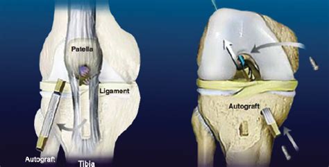 ACL Reconstruction