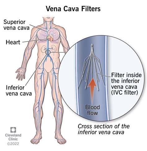 Vena Cava Filters: Purpose & Placement