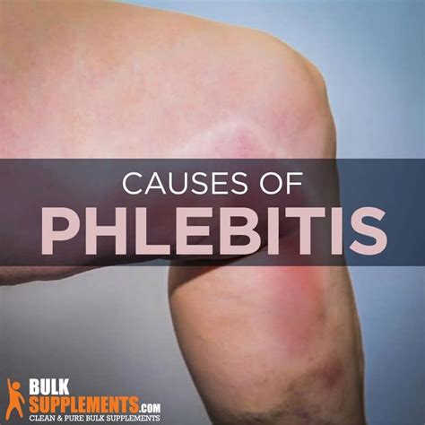 Phlebitis: Symptoms, Causes & Treatment