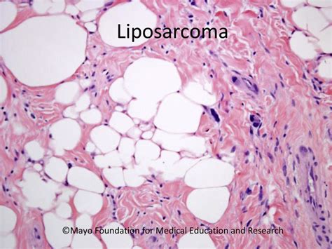 References in Spermatic Cord Liposarcoma - Mayo Clinic Proceedings