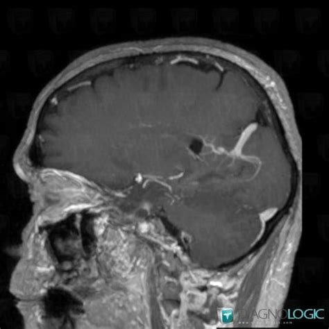 Radiology case : Developmental venous anomaly (MRI) - Diagnologic