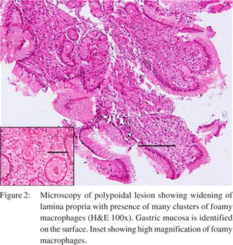 Xanthoma Histology