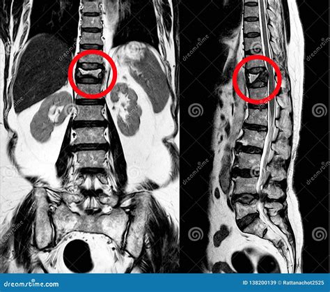 Lumbar Fracture Stock Photo | CartoonDealer.com #43419810