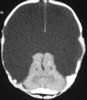 Imaging in Hydranencephaly