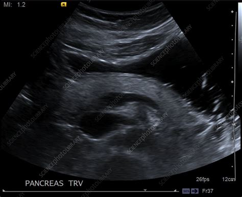 Normal pancreas, ultrasound - Stock Image - C039/3195 - Science Photo Library