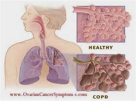 Signs And Symptoms Of Emphysema Women | Signs of emphysema