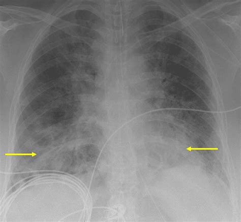 Breathing Labs – A Case Series Demonstrating the Difficulties in Diagnosing COVID-19 Associated ...