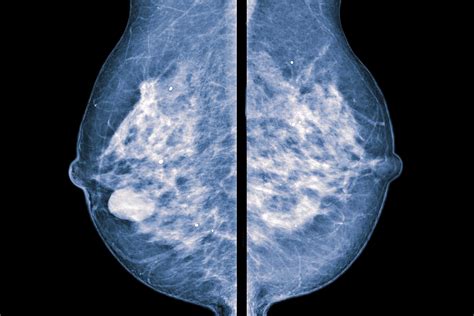 Mammograms & Breast Examination | MD Anderson Cancer Center