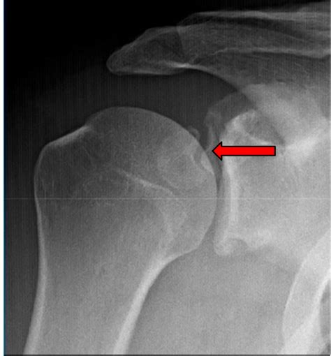 Case Presentation for Arthroscopic Internal Fixation of Coracoid Fracture | Published in Journal ...